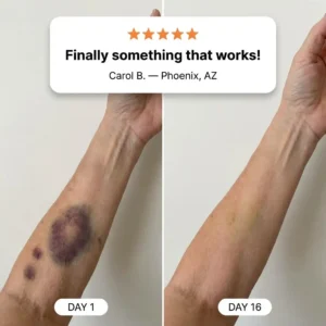 MRAVION® BRUISE REPAIR CREAM